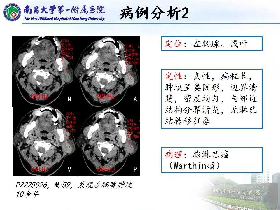 影像PPT - 【PPT】腮腺肿瘤CT诊断分析思路-20