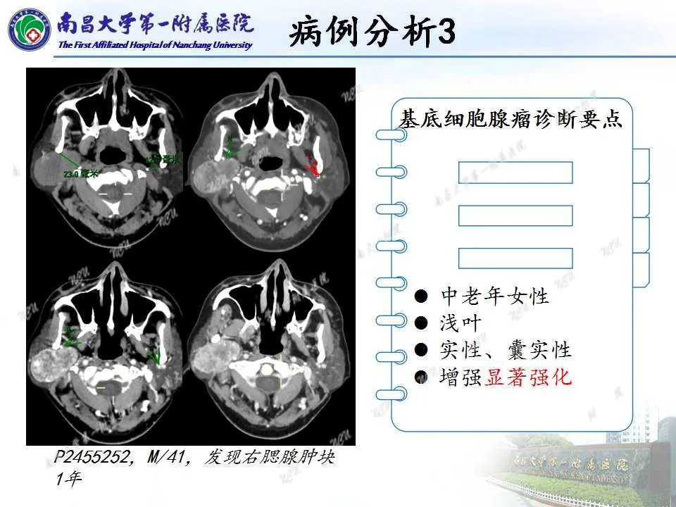 影像PPT - 【PPT】腮腺肿瘤CT诊断分析思路-23