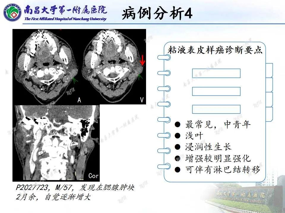 影像PPT - 【PPT】腮腺肿瘤CT诊断分析思路-25