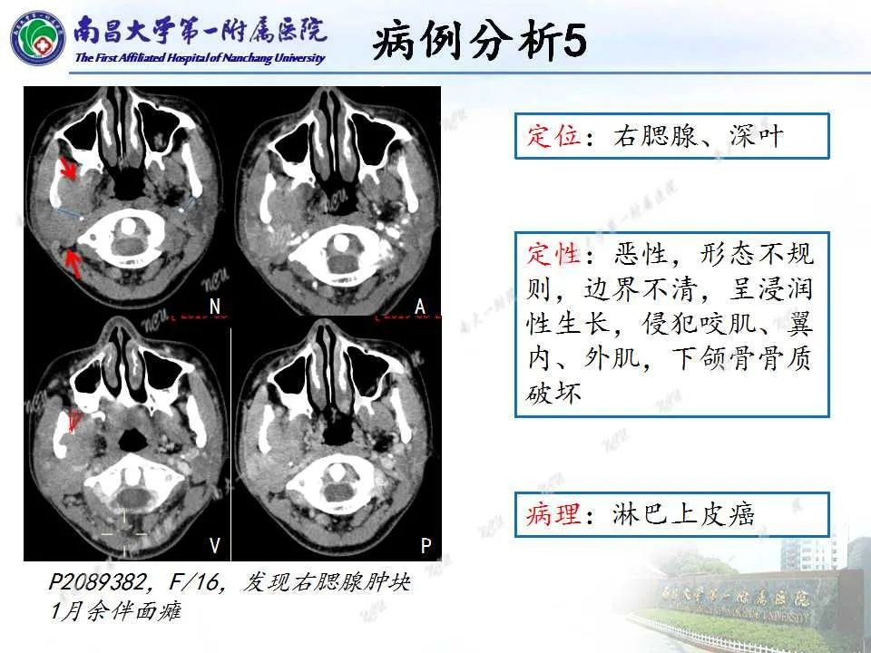 影像PPT - 【PPT】腮腺肿瘤CT诊断分析思路-26