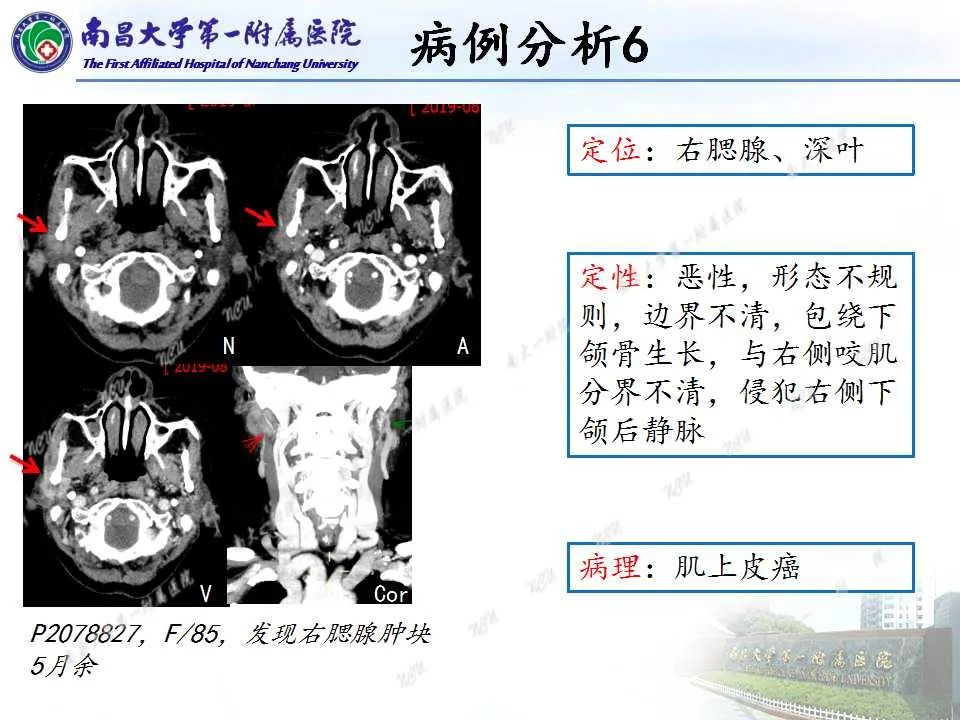 影像PPT - 【PPT】腮腺肿瘤CT诊断分析思路-28