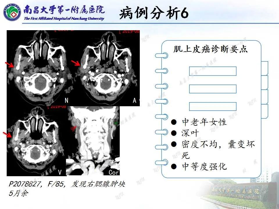 影像PPT - 【PPT】腮腺肿瘤CT诊断分析思路-29