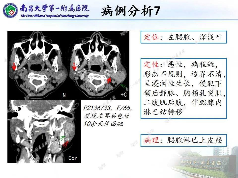 影像PPT - 【PPT】腮腺肿瘤CT诊断分析思路-31