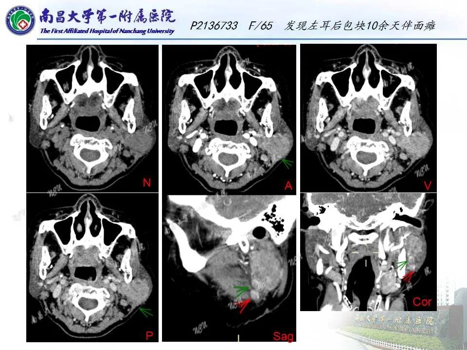 影像PPT - 【PPT】腮腺肿瘤CT诊断分析思路-2