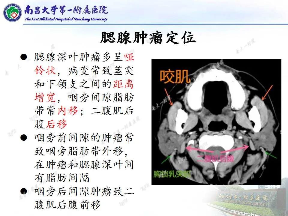 影像PPT - 【PPT】腮腺肿瘤CT诊断分析思路-4