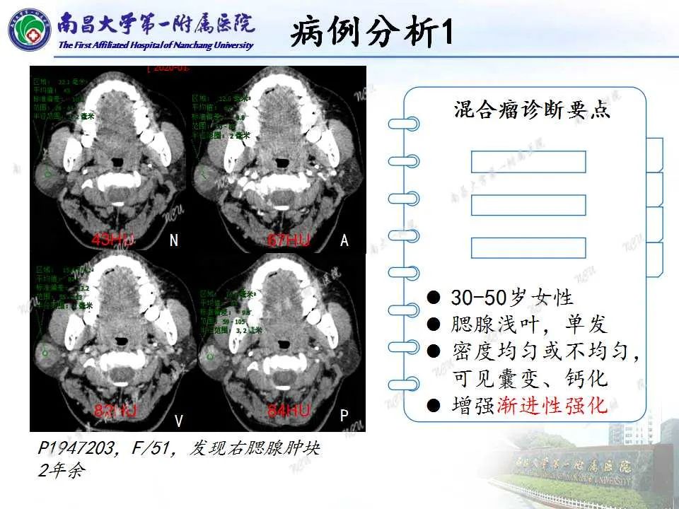 影像PPT - 【PPT】腮腺肿瘤CT诊断分析思路-7