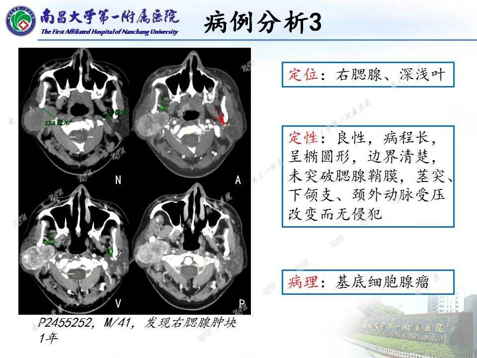 影像PPT - 【PPT】腮腺肿瘤CT诊断分析思路-9
