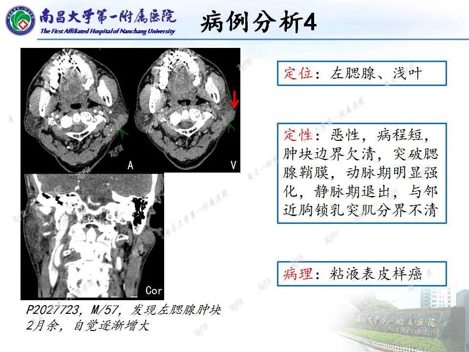 影像PPT - 【PPT】腮腺肿瘤CT诊断分析思路-10