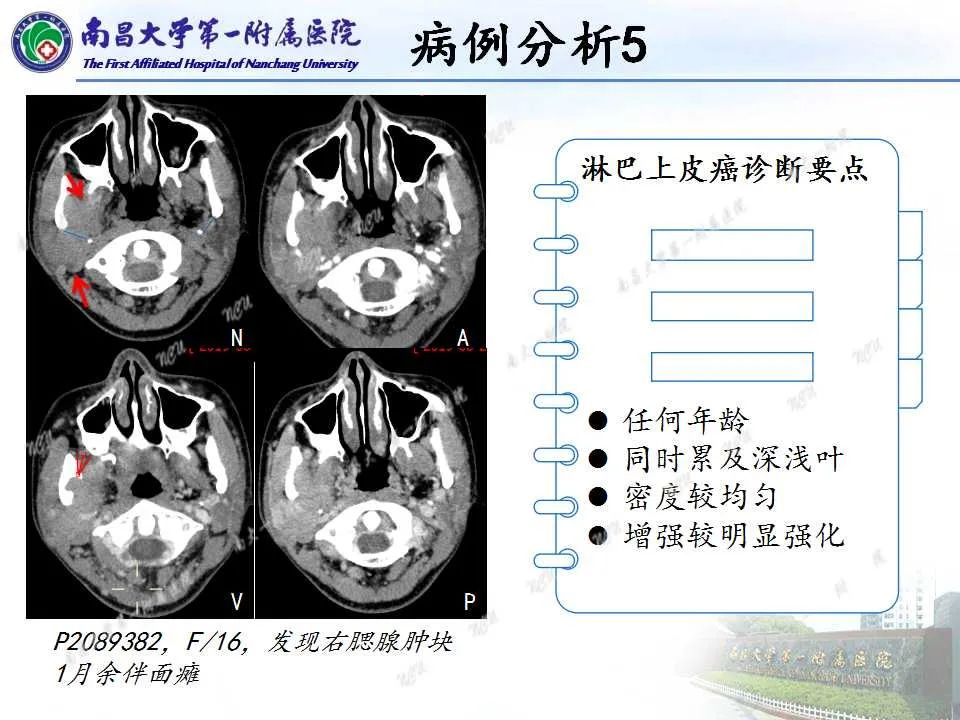 影像PPT - 【PPT】腮腺肿瘤CT诊断分析思路-11