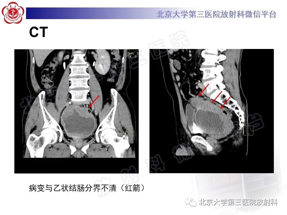 影像PPT - 【PPT】胃肠道间质瘤-5