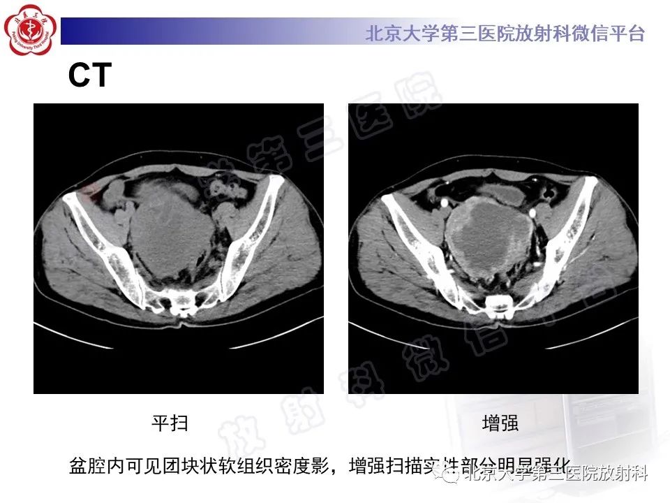 影像PPT - 【PPT】胃肠道间质瘤-3