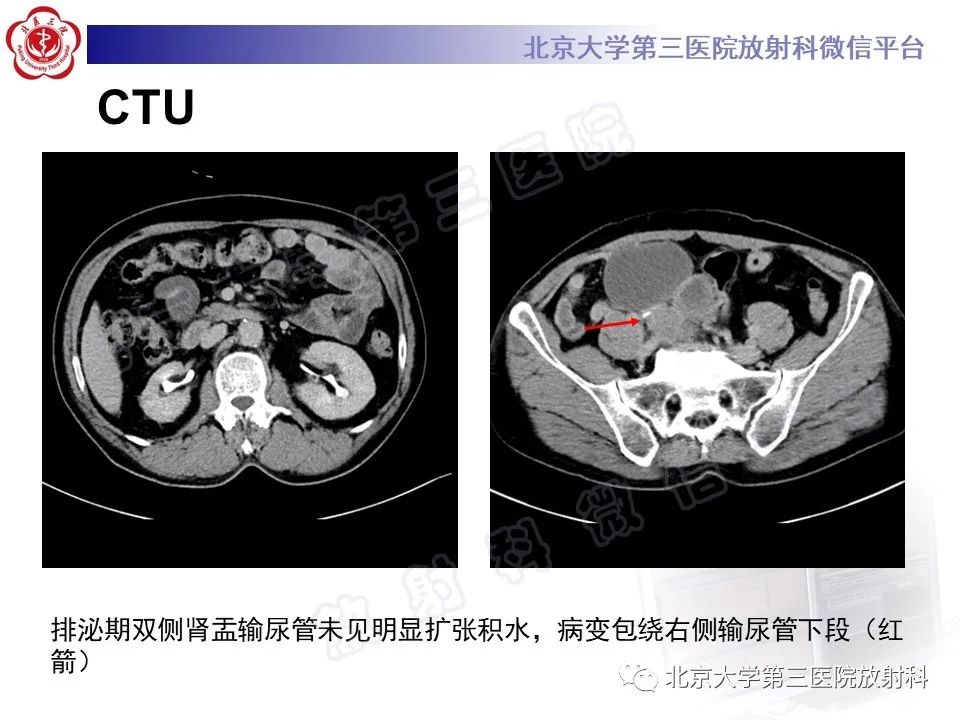 影像PPT - 【PPT】胃肠道间质瘤-4
