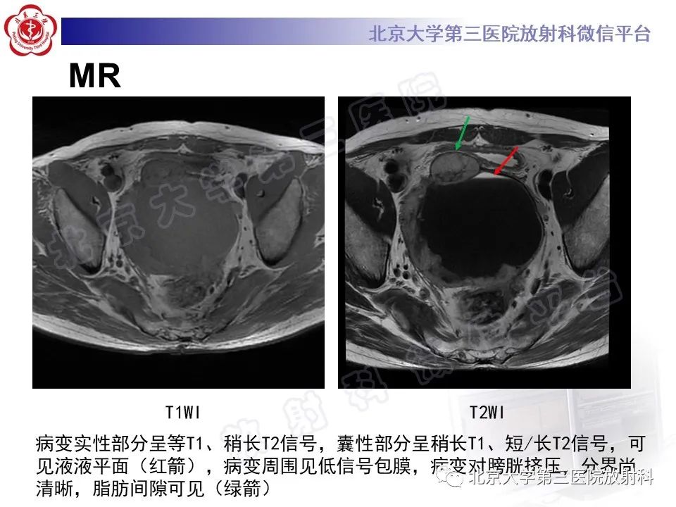 影像PPT - 【PPT】胃肠道间质瘤-6