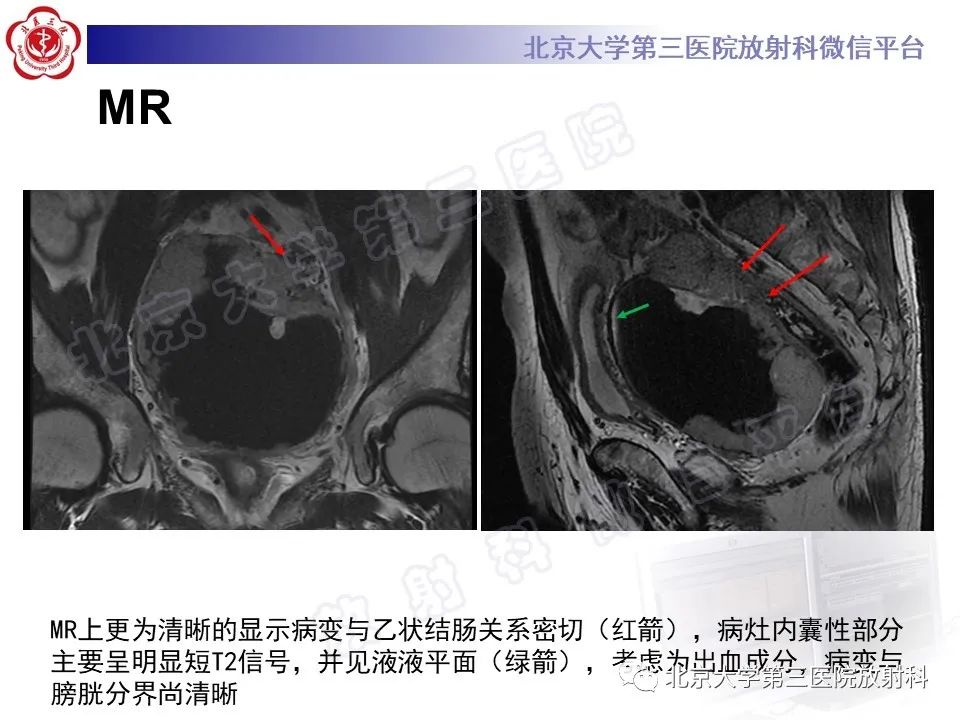 影像PPT - 【PPT】胃肠道间质瘤-8
