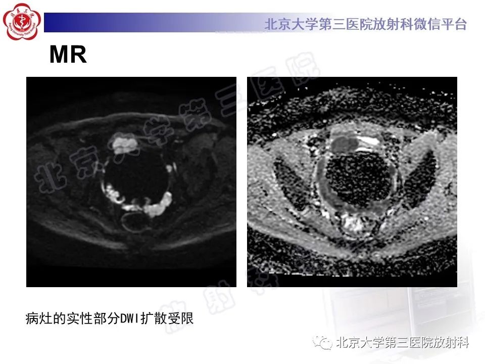 影像PPT - 【PPT】胃肠道间质瘤-7