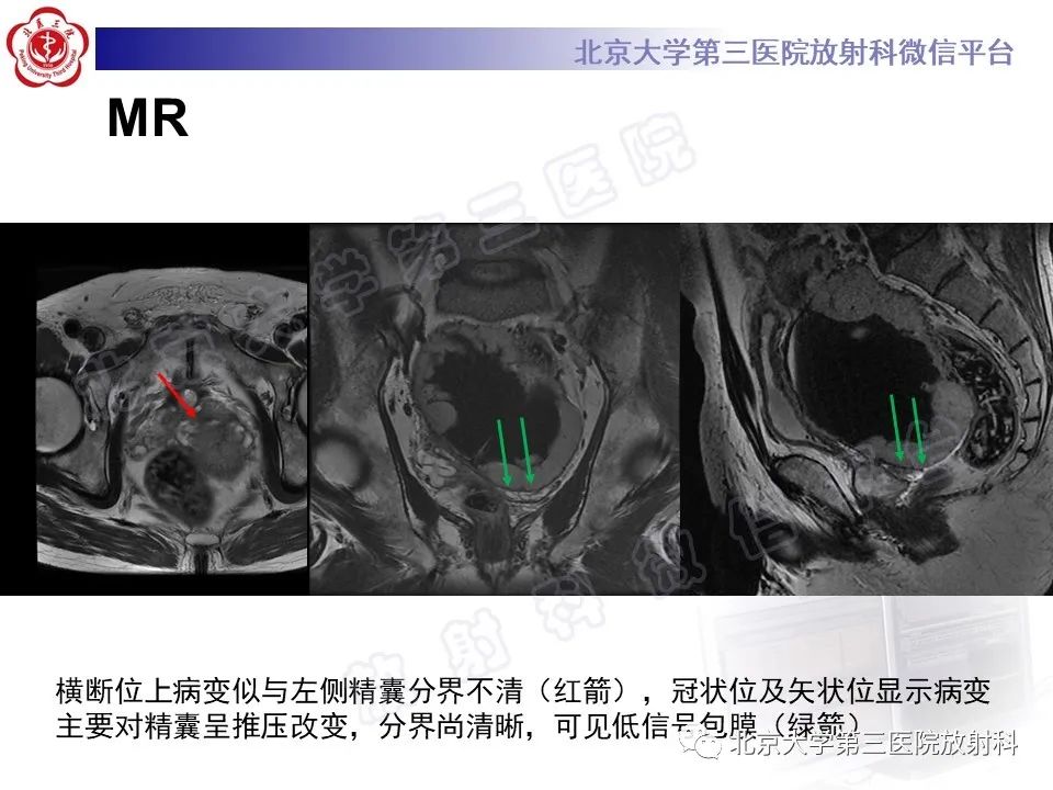 影像PPT - 【PPT】胃肠道间质瘤-9