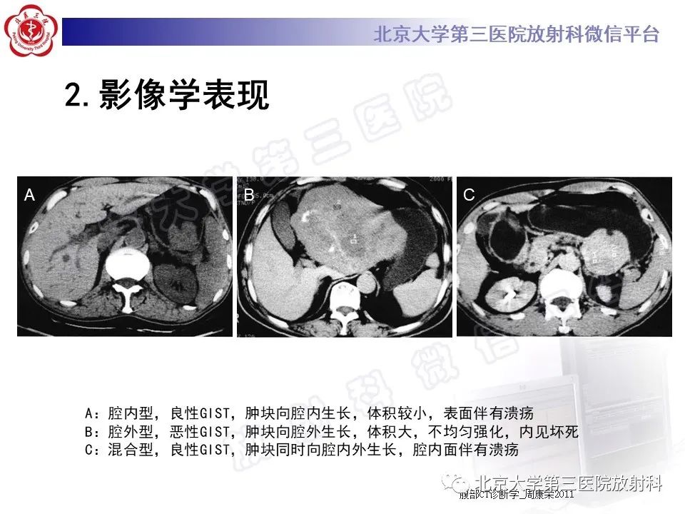影像PPT - 【PPT】胃肠道间质瘤-18