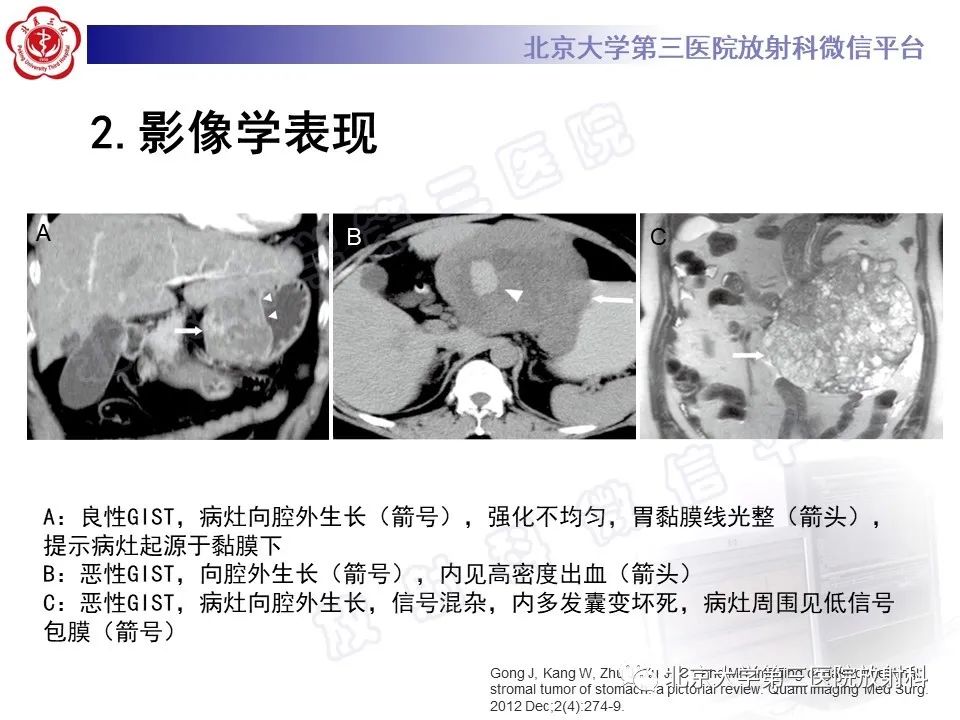 影像PPT - 【PPT】胃肠道间质瘤-19