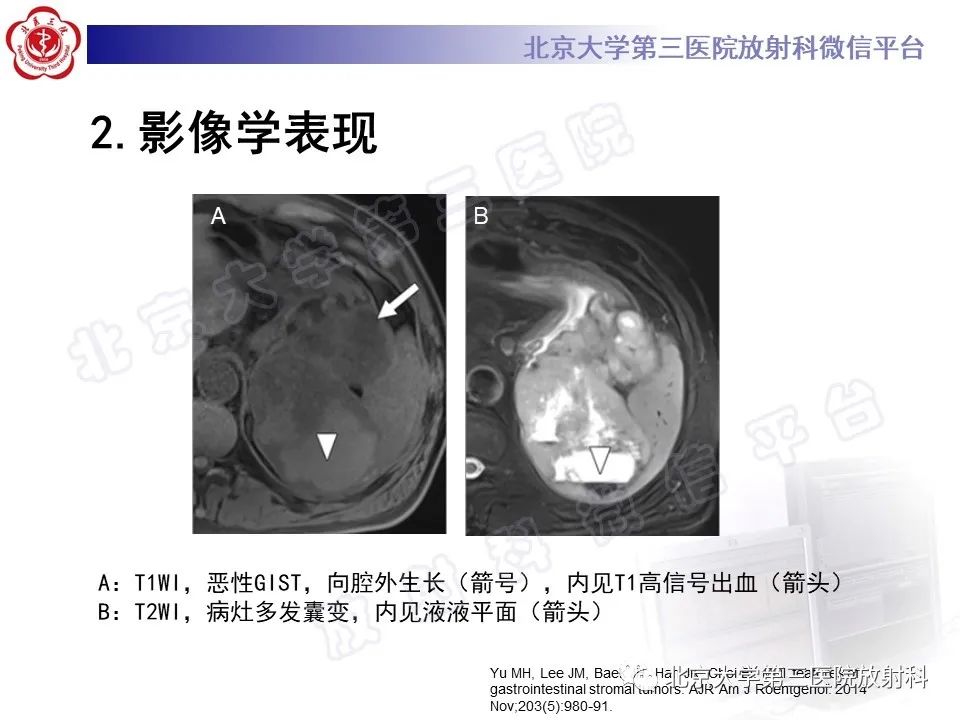 影像PPT - 【PPT】胃肠道间质瘤-20