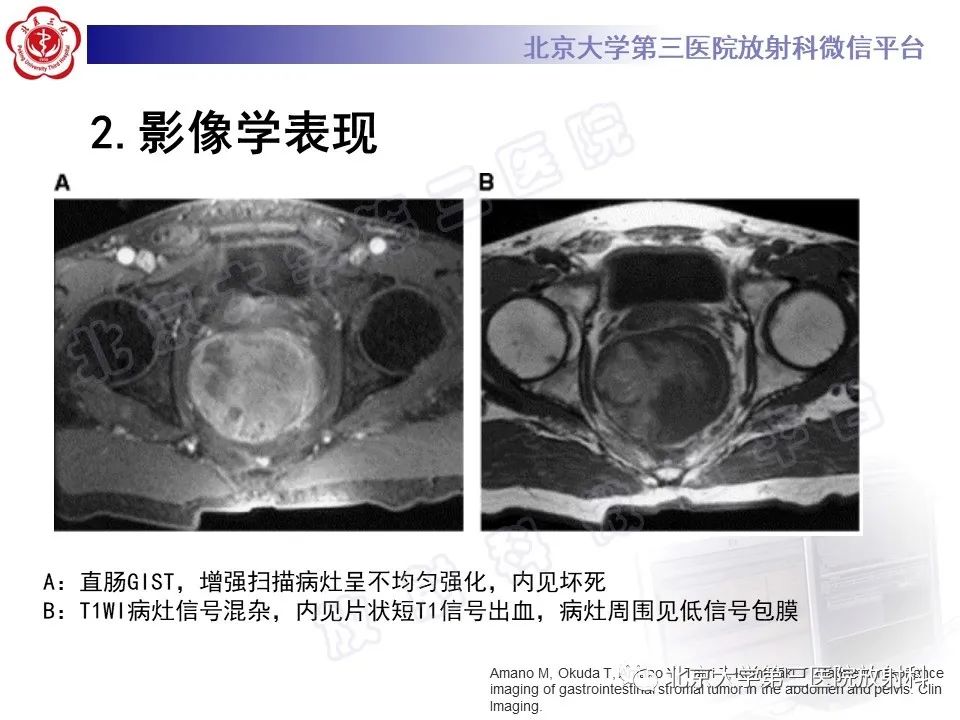 影像PPT - 【PPT】胃肠道间质瘤-21