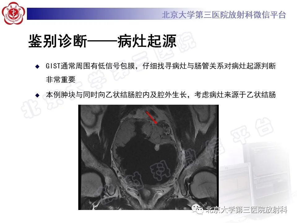 影像PPT - 【PPT】胃肠道间质瘤-23
