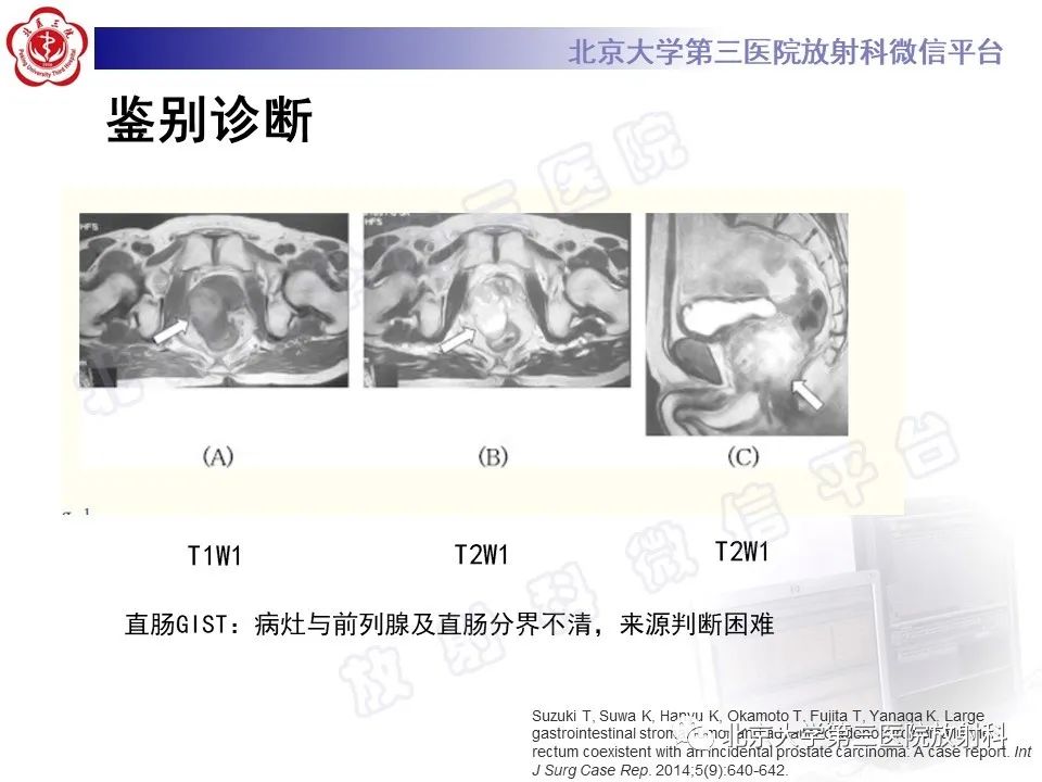 影像PPT - 【PPT】胃肠道间质瘤-25