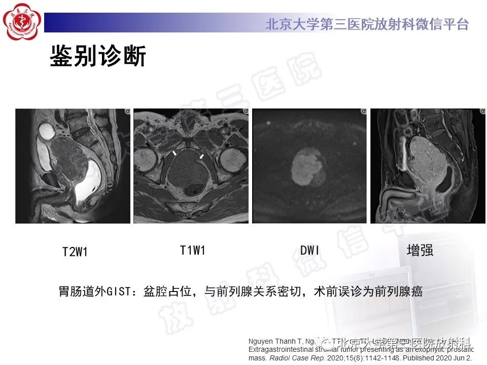 影像PPT - 【PPT】胃肠道间质瘤-24
