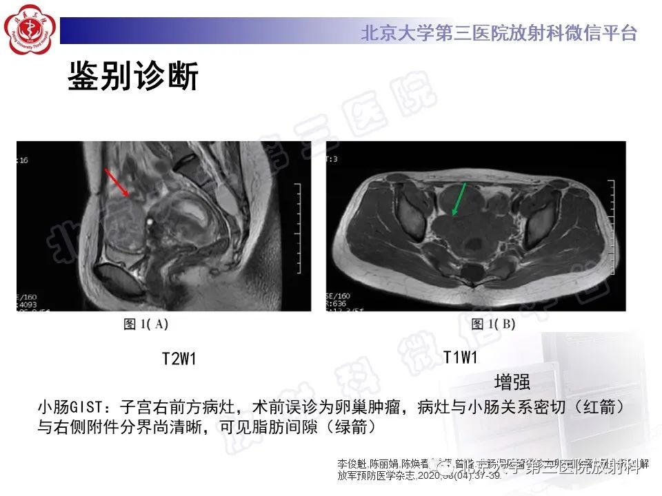 影像PPT - 【PPT】胃肠道间质瘤-26