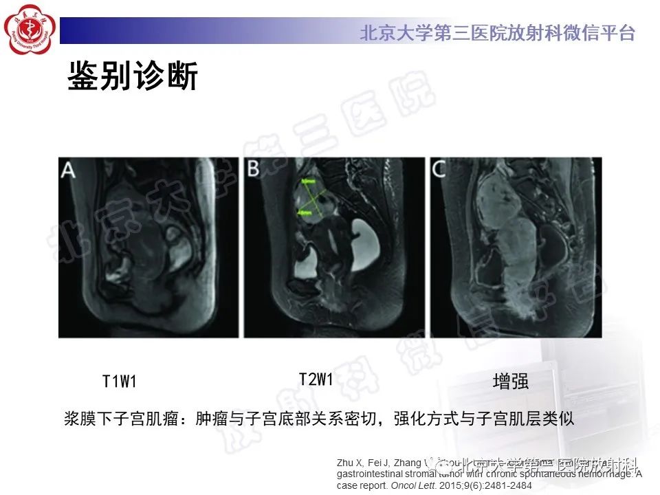 影像PPT - 【PPT】胃肠道间质瘤-27