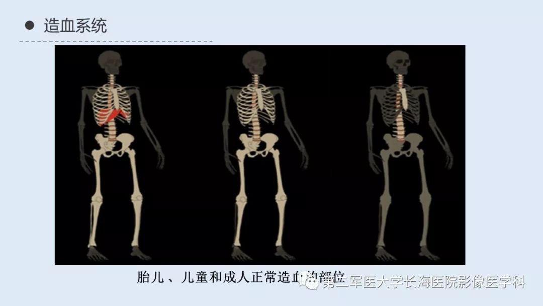 影像PPT - 【PPT】髓外造血的影像诊断-3 影像PPT - 【PPT】髓外造血的影像诊断-3