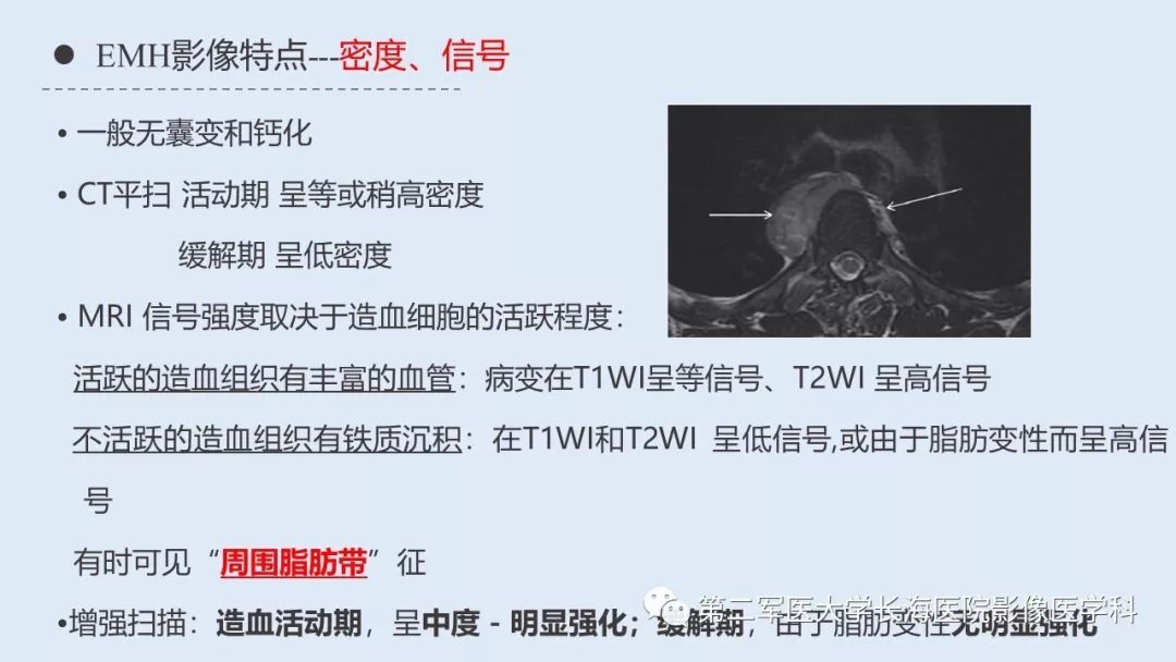 影像PPT - 【PPT】髓外造血的影像诊断-9 影像PPT - 【PPT】髓外造血的影像诊断-9