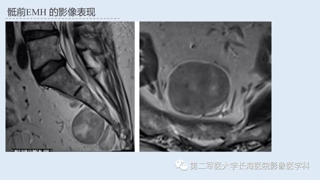 影像PPT - 【PPT】髓外造血的影像诊断-14 影像PPT - 【PPT】髓外造血的影像诊断-14