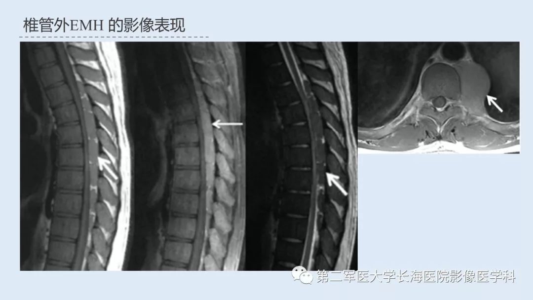 影像PPT - 【PPT】髓外造血的影像诊断-19 影像PPT - 【PPT】髓外造血的影像诊断-19