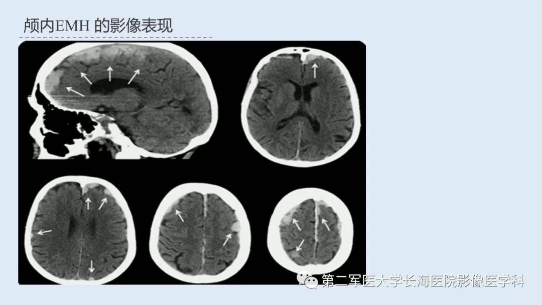 影像PPT - 【PPT】髓外造血的影像诊断-29 影像PPT - 【PPT】髓外造血的影像诊断-29