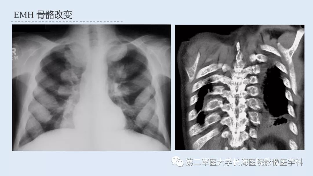 影像PPT - 【PPT】髓外造血的影像诊断-32 影像PPT - 【PPT】髓外造血的影像诊断-32