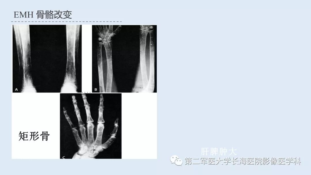 影像PPT - 【PPT】髓外造血的影像诊断-35 影像PPT - 【PPT】髓外造血的影像诊断-35