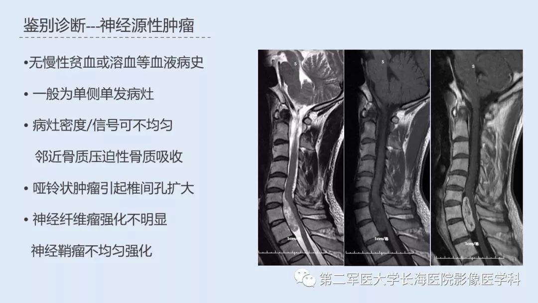 影像PPT - 【PPT】髓外造血的影像诊断-36 影像PPT - 【PPT】髓外造血的影像诊断-36