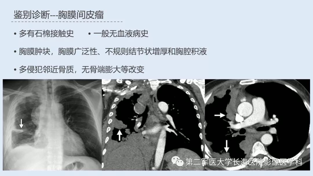 影像PPT - 【PPT】髓外造血的影像诊断-38 影像PPT - 【PPT】髓外造血的影像诊断-38