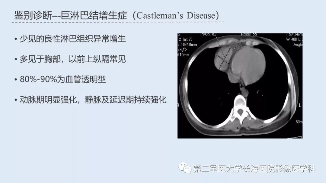 影像PPT - 【PPT】髓外造血的影像诊断-39 影像PPT - 【PPT】髓外造血的影像诊断-39
