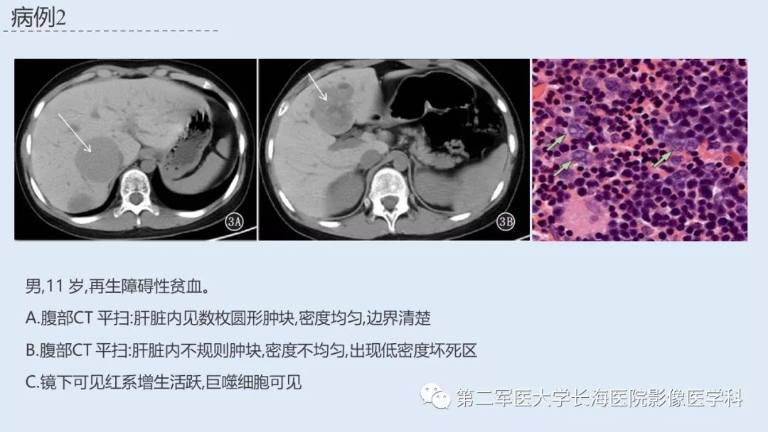 影像PPT - 【PPT】髓外造血的影像诊断-43 影像PPT - 【PPT】髓外造血的影像诊断-43