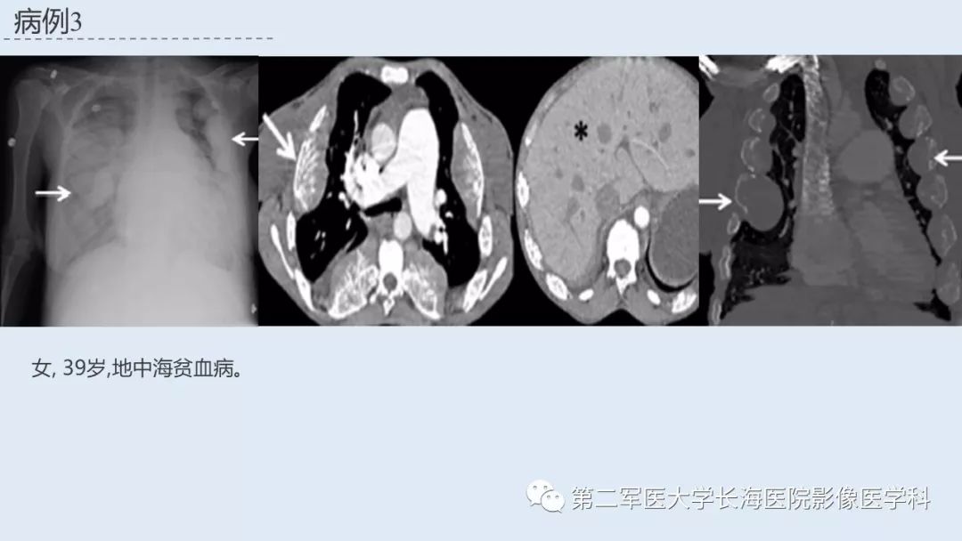 影像PPT - 【PPT】髓外造血的影像诊断-44 影像PPT - 【PPT】髓外造血的影像诊断-44