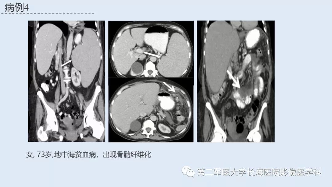 影像PPT - 【PPT】髓外造血的影像诊断-45 影像PPT - 【PPT】髓外造血的影像诊断-45