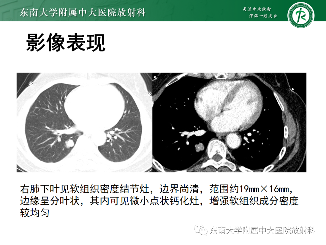 影像PPT - 【PPT】肺硬化性肺细胞瘤-2