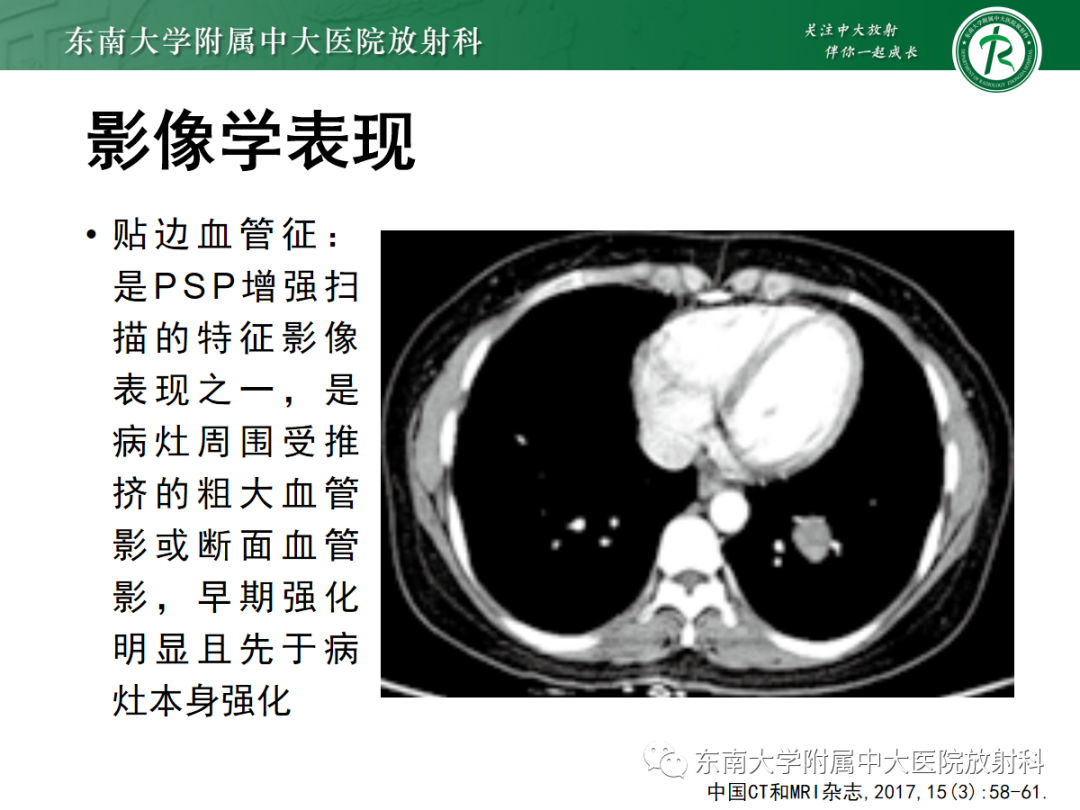 影像PPT - 【PPT】肺硬化性肺细胞瘤-10