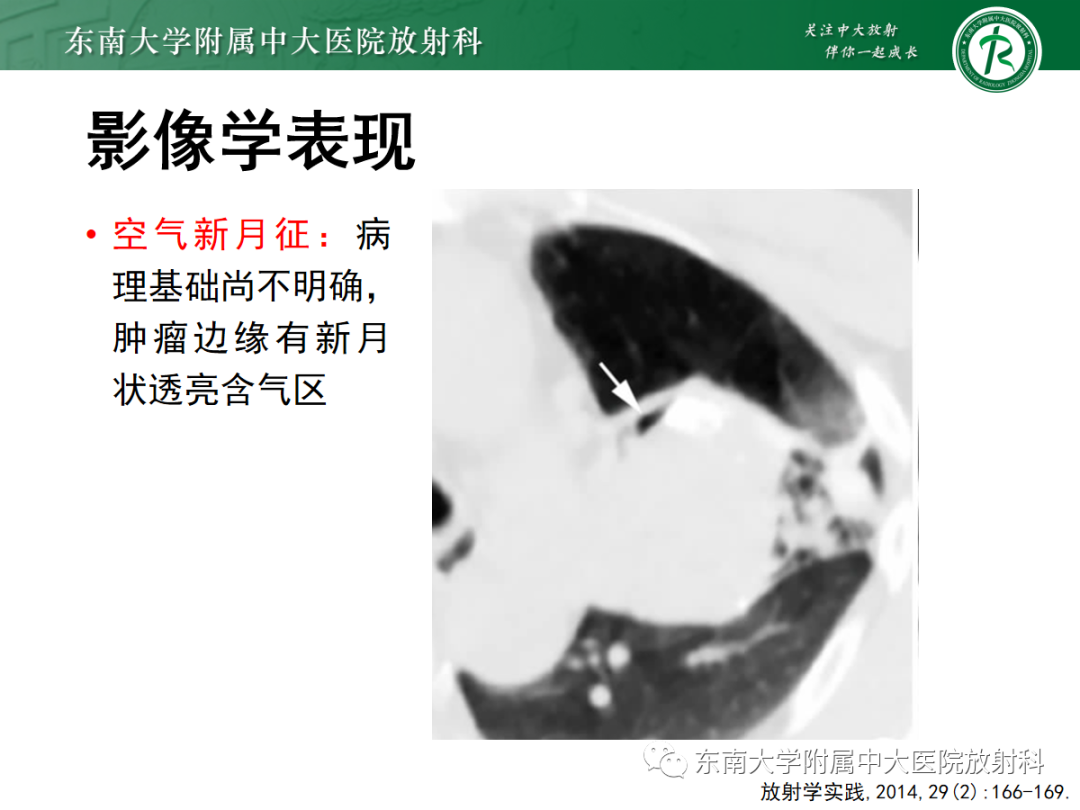 影像PPT - 【PPT】肺硬化性肺细胞瘤-9