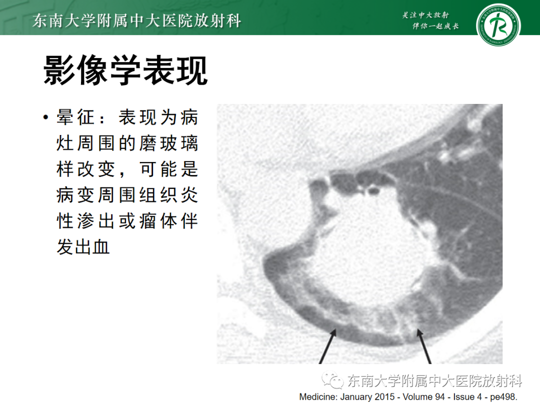 影像PPT - 【PPT】肺硬化性肺细胞瘤-11