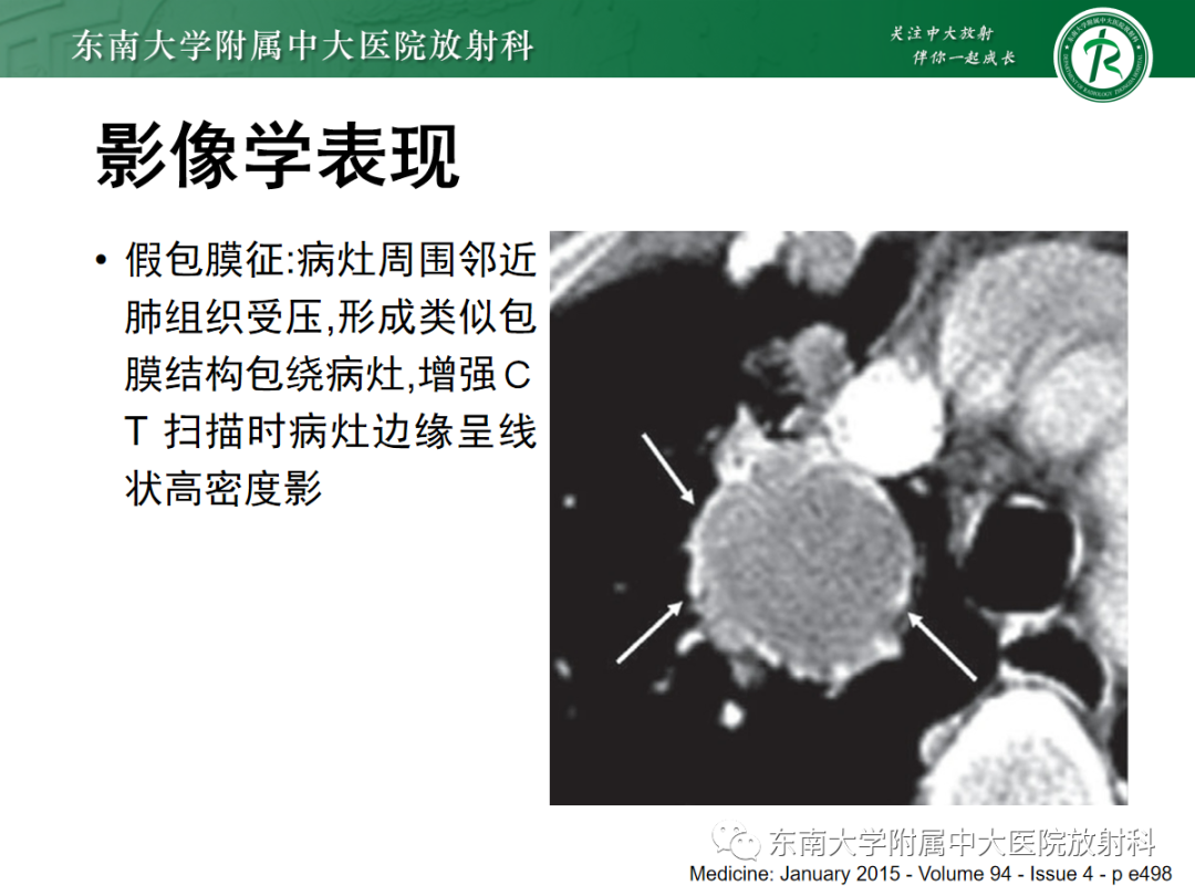 影像PPT - 【PPT】肺硬化性肺细胞瘤-12