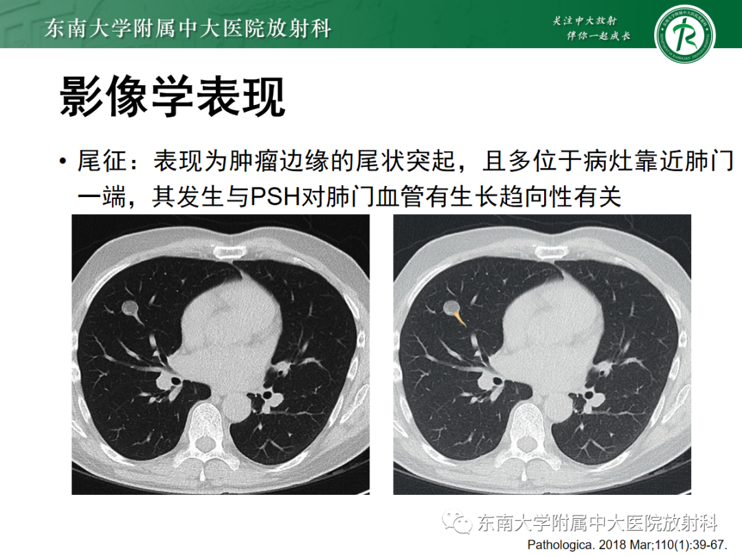 影像PPT - 【PPT】肺硬化性肺细胞瘤-13