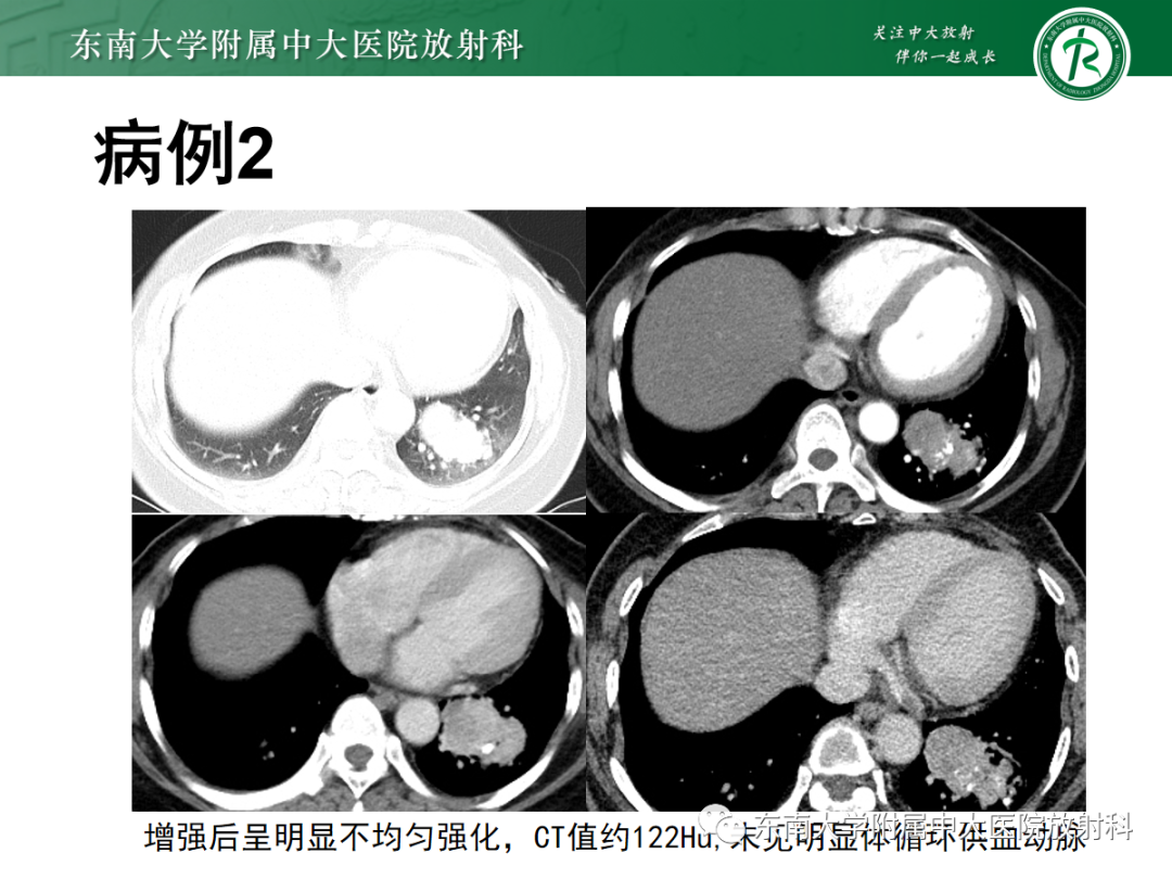 影像PPT - 【PPT】肺硬化性肺细胞瘤-16