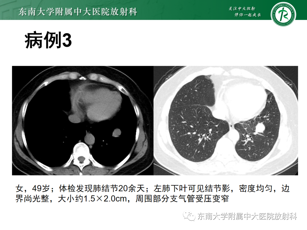 影像PPT - 【PPT】肺硬化性肺细胞瘤-18